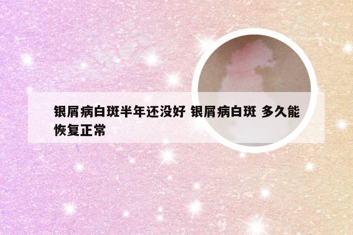 银屑病白斑半年还没好 银屑病白斑 多久能恢复正常