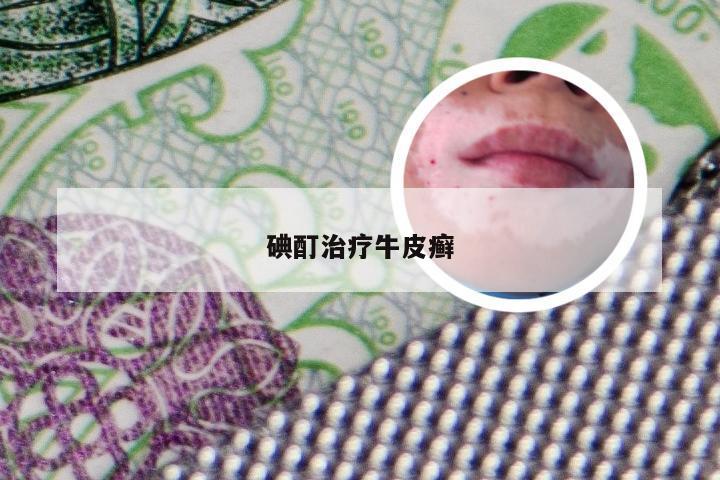 碘酊治疗牛皮癣