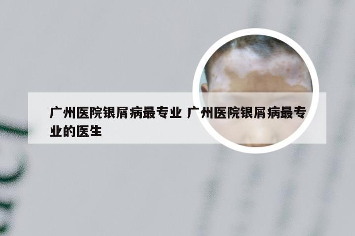 广州医院银屑病最专业 广州医院银屑病最专业的医生