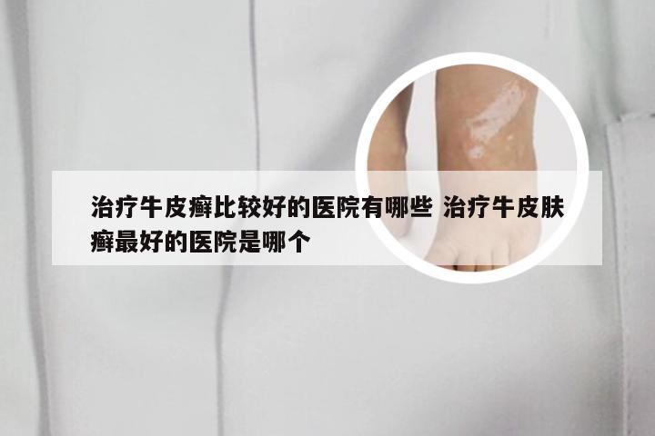 治疗牛皮癣比较好的医院有哪些 治疗牛皮肤癣最好的医院是哪个