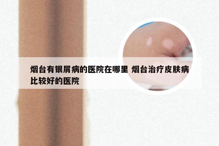 烟台有银屑病的医院在哪里 烟台治疗皮肤病比较好的医院