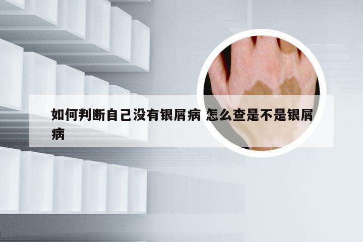 如何判断自己没有银屑病 怎么查是不是银屑病