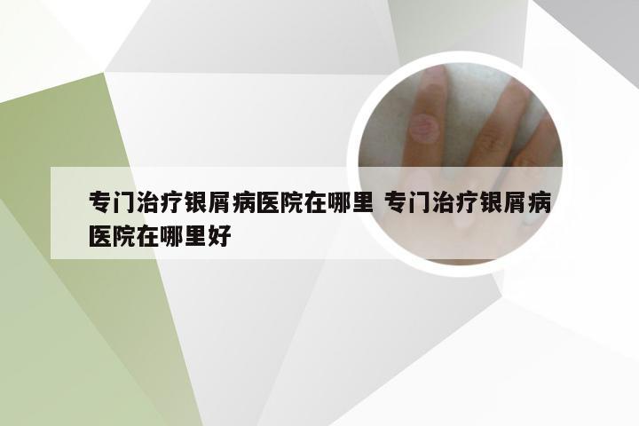 专门治疗银屑病医院在哪里 专门治疗银屑病医院在哪里好