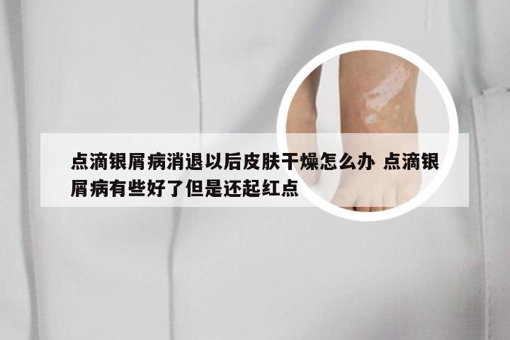 点滴银屑病消退以后皮肤干燥怎么办 点滴银屑病有些好了但是还起红点