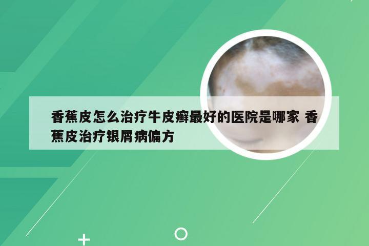 香蕉皮怎么治疗牛皮癣最好的医院是哪家 香蕉皮治疗银屑病偏方