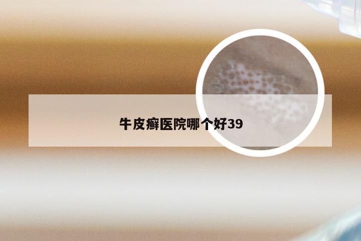 牛皮癣医院哪个好39