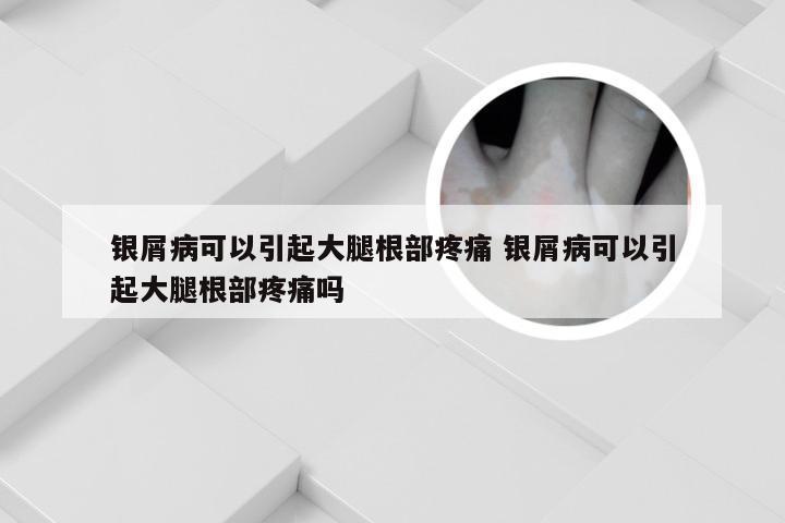 银屑病可以引起大腿根部疼痛 银屑病可以引起大腿根部疼痛吗