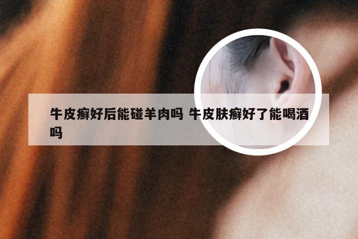 牛皮癣好后能碰羊肉吗 牛皮肤癣好了能喝酒吗