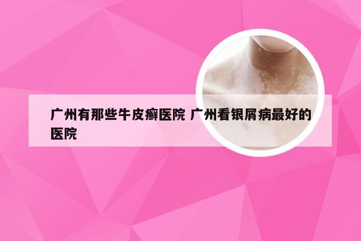 广州有那些牛皮癣医院 广州看银屑病最好的医院