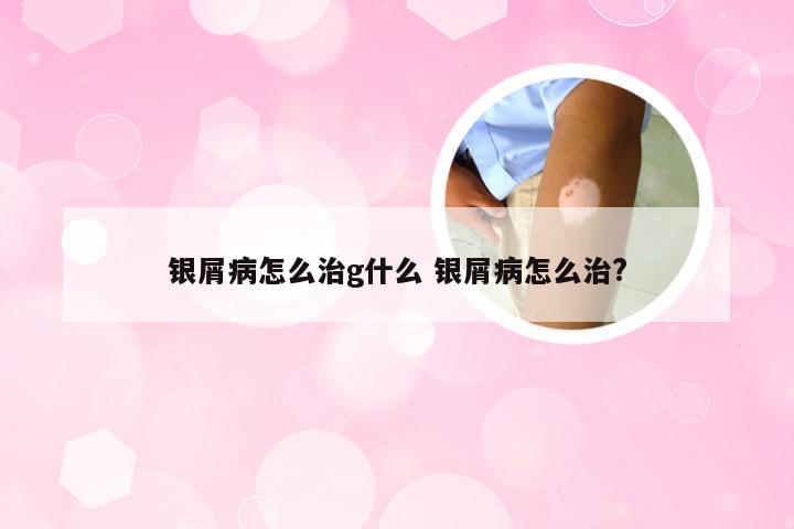 银屑病怎么治g什么 银屑病怎么治?