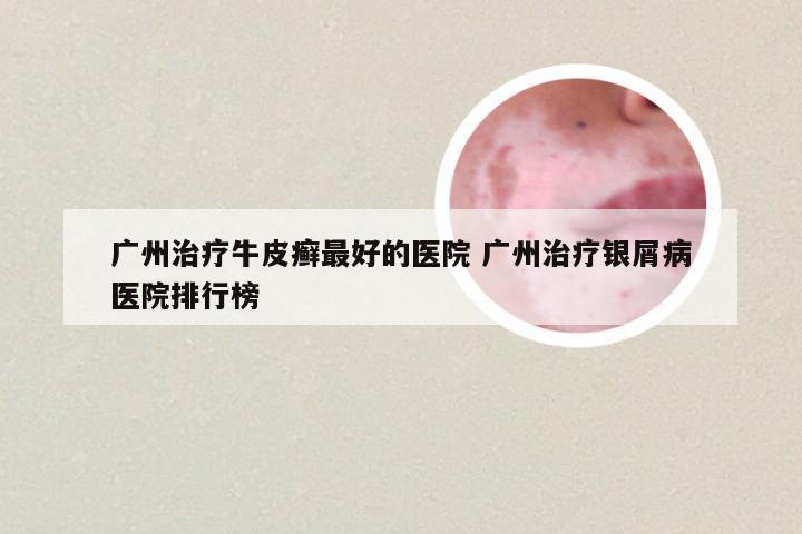 广州治疗牛皮癣最好的医院 广州治疗银屑病医院排行榜
