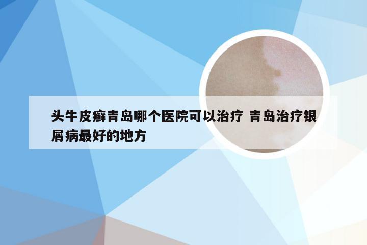 头牛皮癣青岛哪个医院可以治疗 青岛治疗银屑病最好的地方