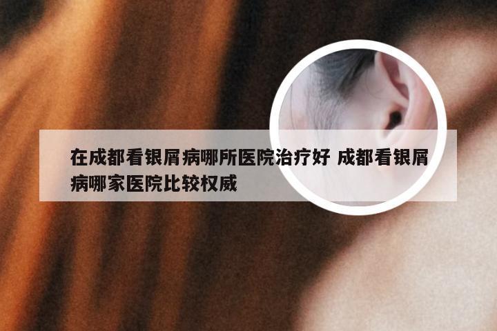 在成都看银屑病哪所医院治疗好 成都看银屑病哪家医院比较权威