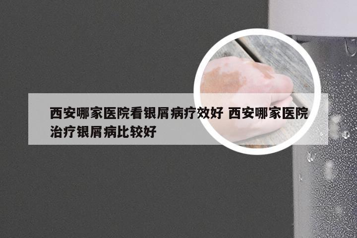 西安哪家医院看银屑病疗效好 西安哪家医院治疗银屑病比较好