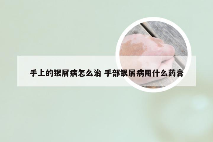 手上的银屑病怎么治 手部银屑病用什么药膏