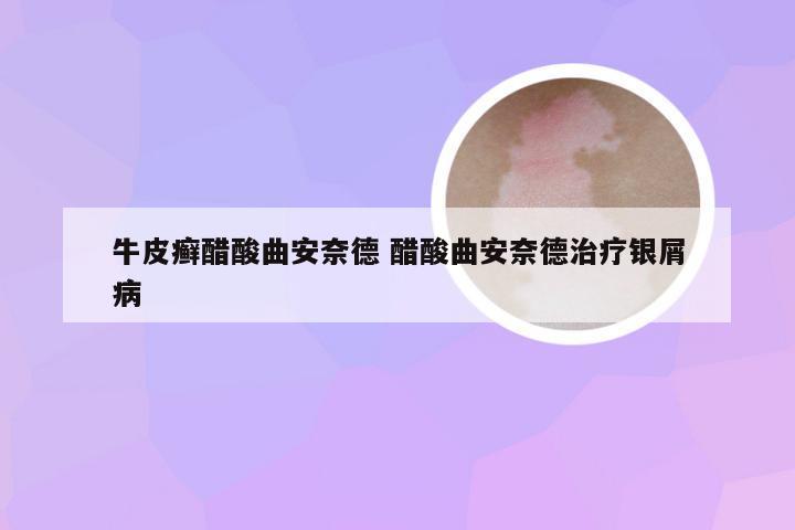 牛皮癣醋酸曲安奈德 醋酸曲安奈德治疗银屑病