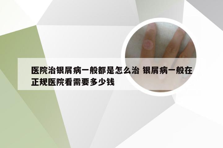 医院治银屑病一般都是怎么治 银屑病一般在正规医院看需要多少钱