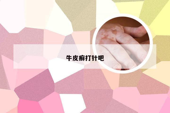 牛皮癣打针吧
