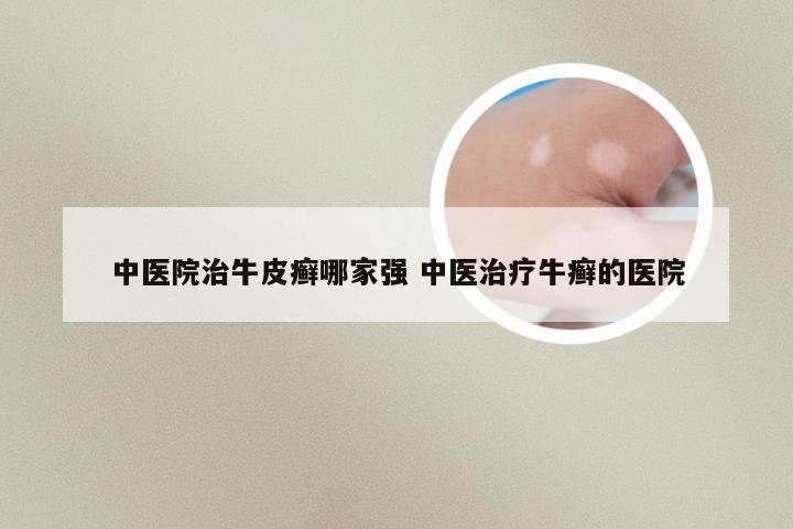 中医院治牛皮癣哪家强 中医治疗牛癣的医院