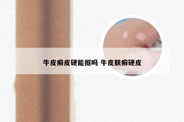 牛皮癣皮硬能抠吗 牛皮肤癣硬皮