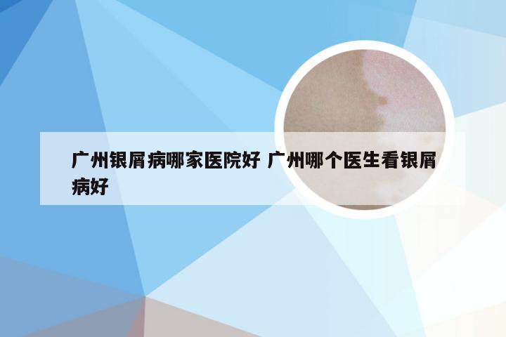 广州银屑病哪家医院好 广州哪个医生看银屑病好