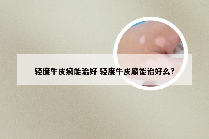 轻度牛皮癣能治好 轻度牛皮廨能治好么?