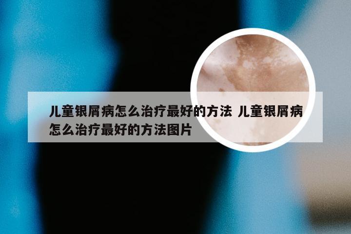 儿童银屑病怎么治疗最好的方法 儿童银屑病怎么治疗最好的方法图片