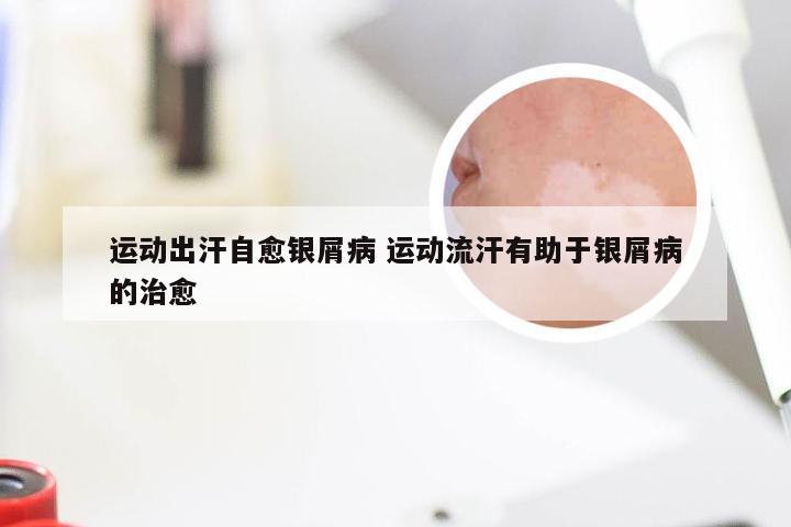 运动出汗自愈银屑病 运动流汗有助于银屑病的治愈