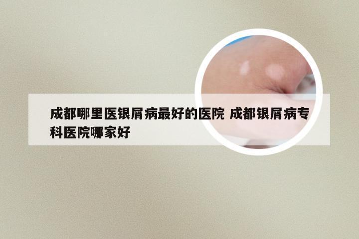 成都哪里医银屑病最好的医院 成都银屑病专科医院哪家好