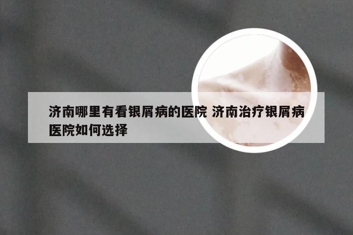 济南哪里有看银屑病的医院 济南治疗银屑病医院如何选择