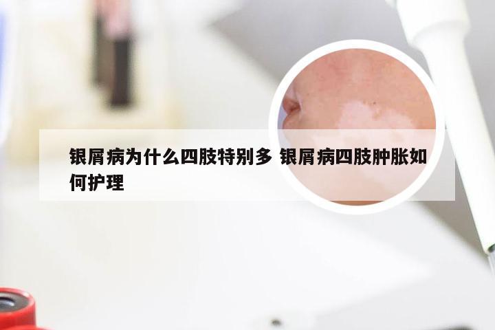 银屑病为什么四肢特别多 银屑病四肢肿胀如何护理