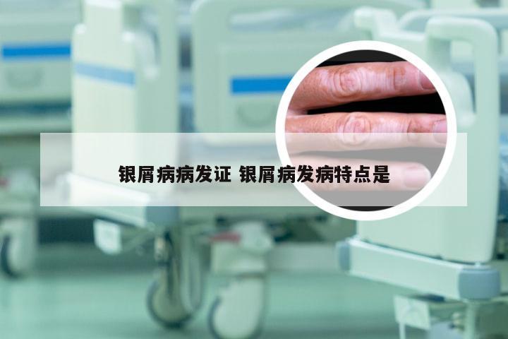 银屑病病发证 银屑病发病特点是