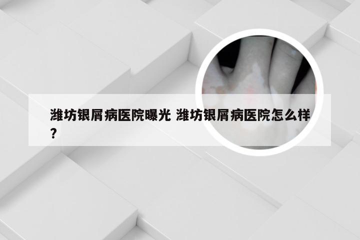 潍坊银屑病医院曝光 潍坊银屑病医院怎么样?