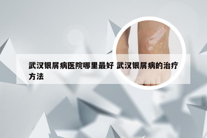 武汉银屑病医院哪里最好 武汉银屑病的治疗方法