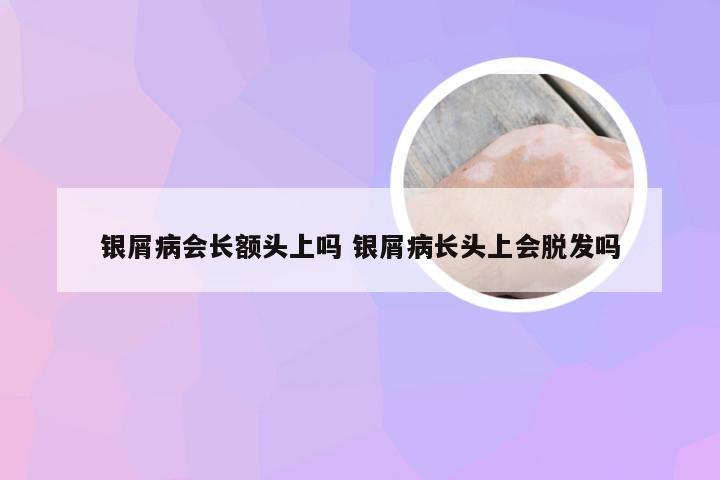 银屑病会长额头上吗 银屑病长头上会脱发吗