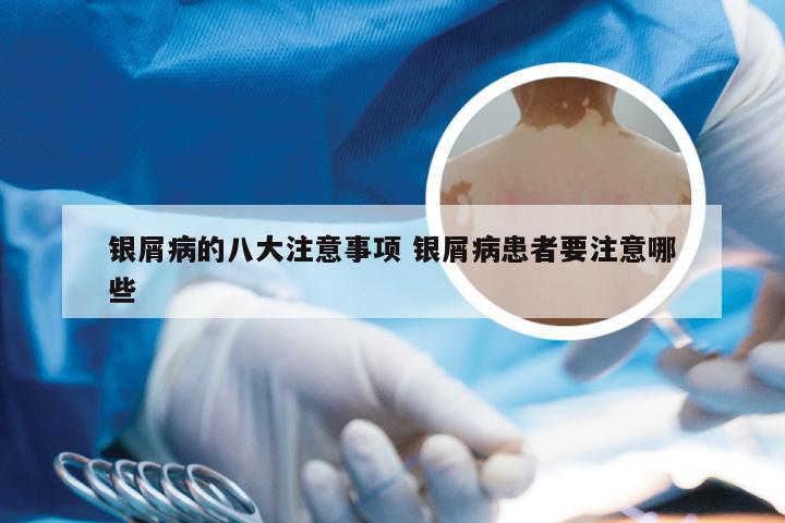银屑病的八大注意事项 银屑病患者要注意哪些