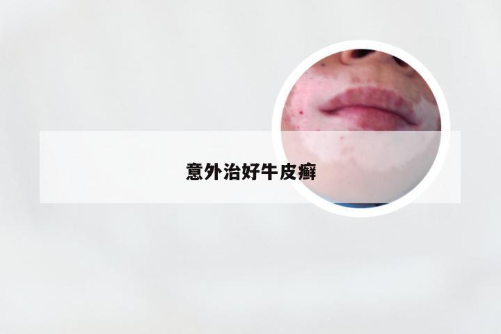 意外治好牛皮癣