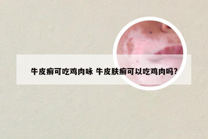 牛皮癣可吃鸡肉咏 牛皮肤癣可以吃鸡肉吗?