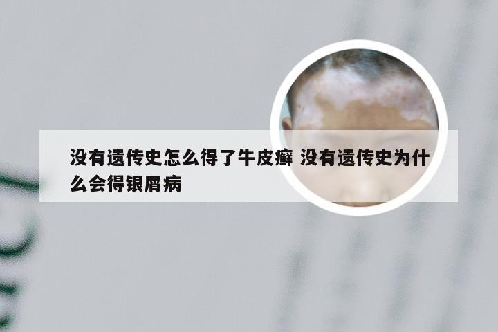 没有遗传史怎么得了牛皮癣 没有遗传史为什么会得银屑病