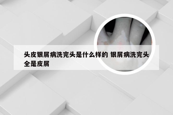 头皮银屑病洗完头是什么样的 银屑病洗完头全是皮屑