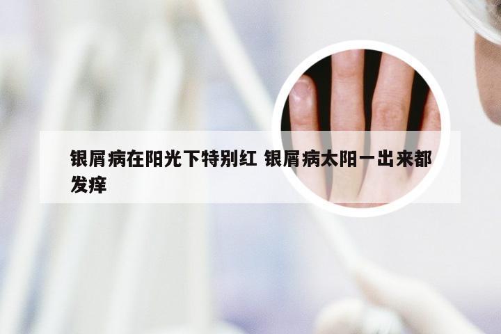 银屑病在阳光下特别红 银屑病太阳一出来都发痒