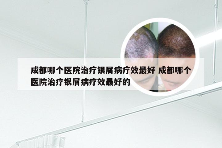 成都哪个医院治疗银屑病疗效最好 成都哪个医院治疗银屑病疗效最好的