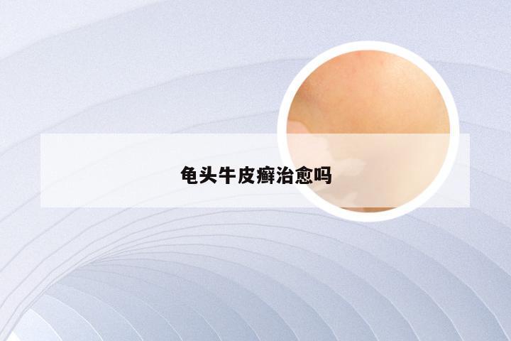 龟头牛皮癣治愈吗