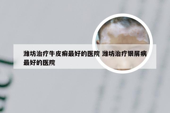 潍坊治疗牛皮癣最好的医院 潍坊治疗银屑病最好的医院