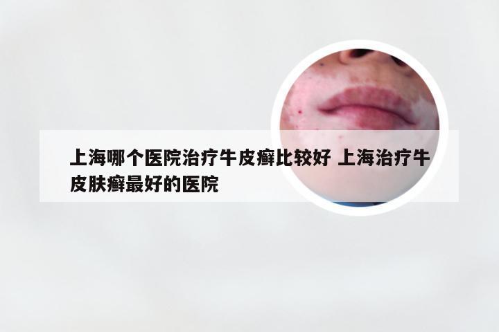上海哪个医院治疗牛皮癣比较好 上海治疗牛皮肤癣最好的医院