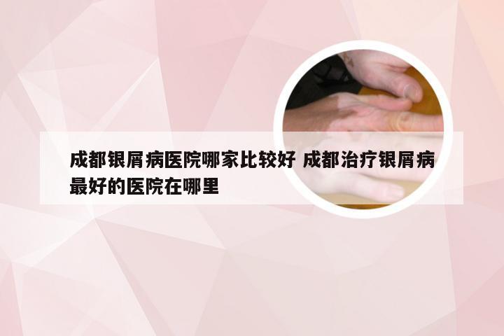 成都银屑病医院哪家比较好 成都治疗银屑病最好的医院在哪里