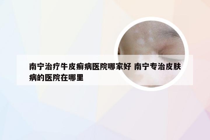 南宁治疗牛皮癣病医院哪家好 南宁专治皮肤病的医院在哪里