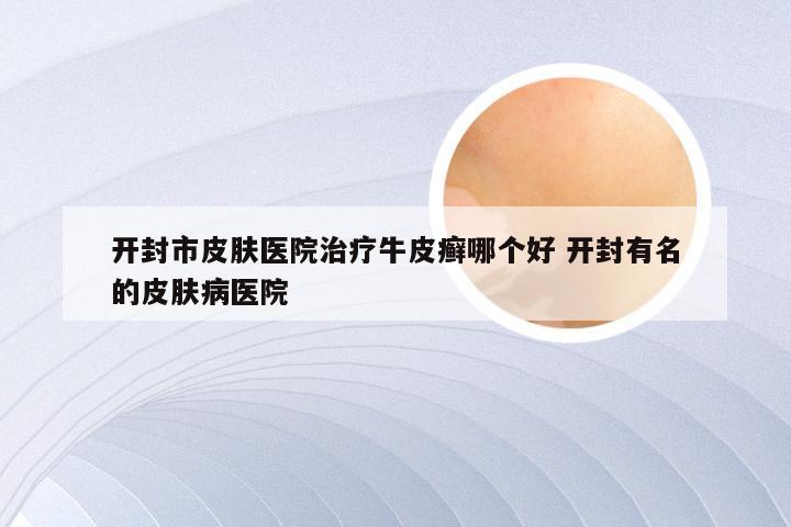 开封市皮肤医院治疗牛皮癣哪个好 开封有名的皮肤病医院