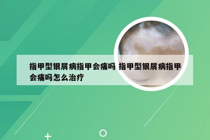 指甲型银屑病指甲会痛吗 指甲型银屑病指甲会痛吗怎么治疗