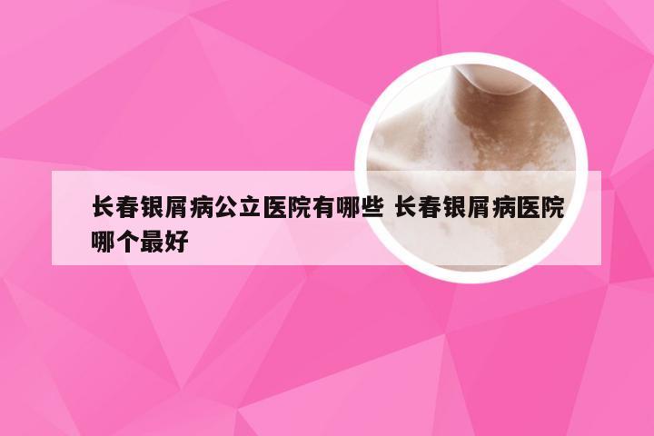 长春银屑病公立医院有哪些 长春银屑病医院哪个最好
